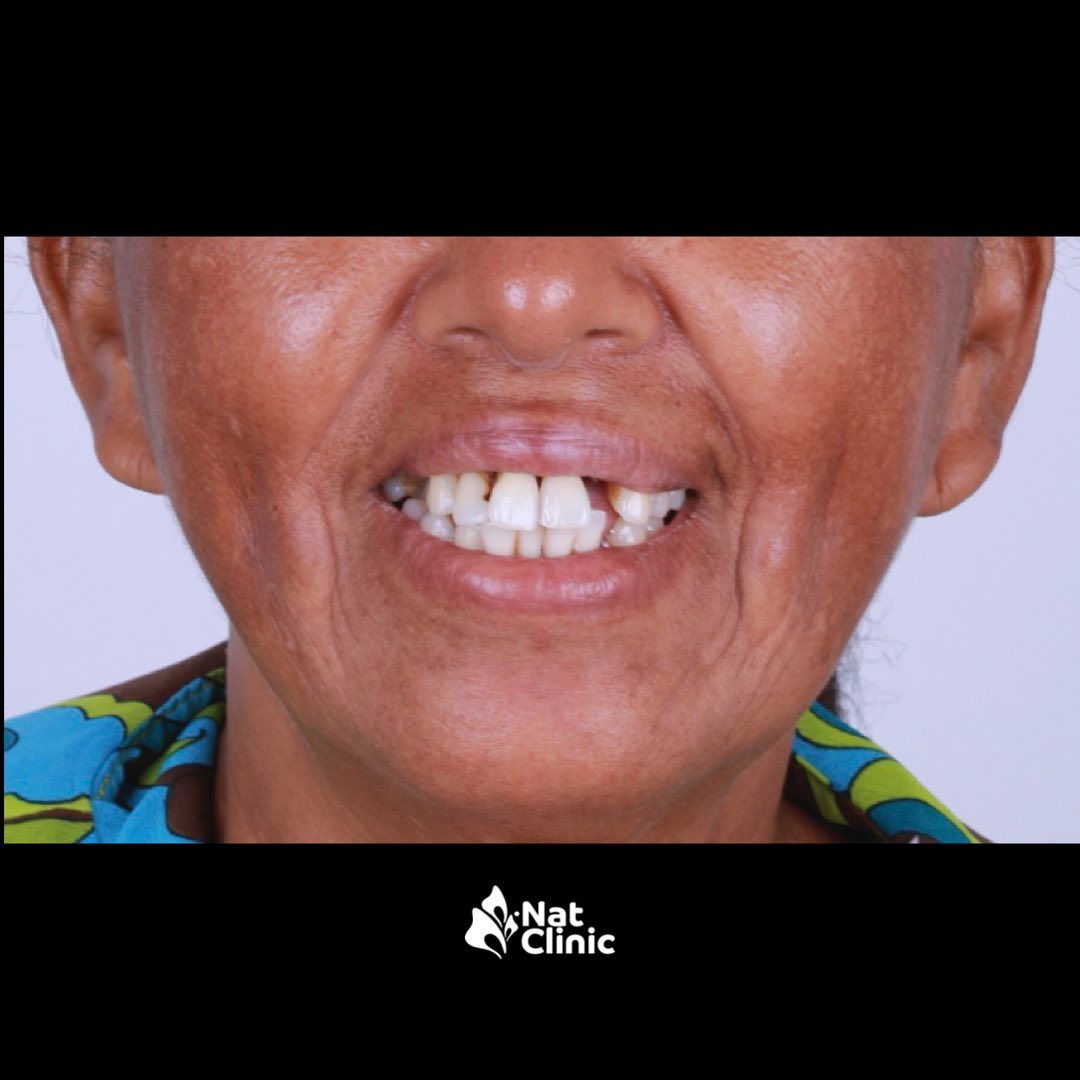 Transformación de sonrisa - Antes